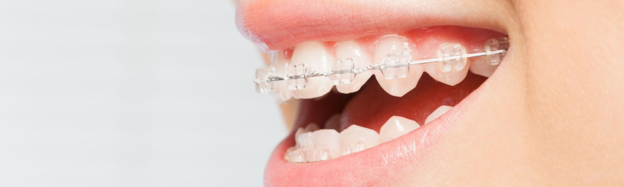 Understanding Porcelain Ceramic Braces